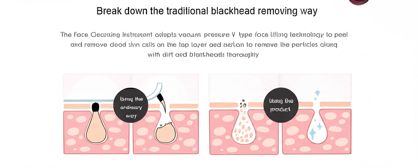 The image is a visual representation of the traditional blackhead removal method, showing the process of using a vacuum and a lifting technique to remove blackheads from the skin.