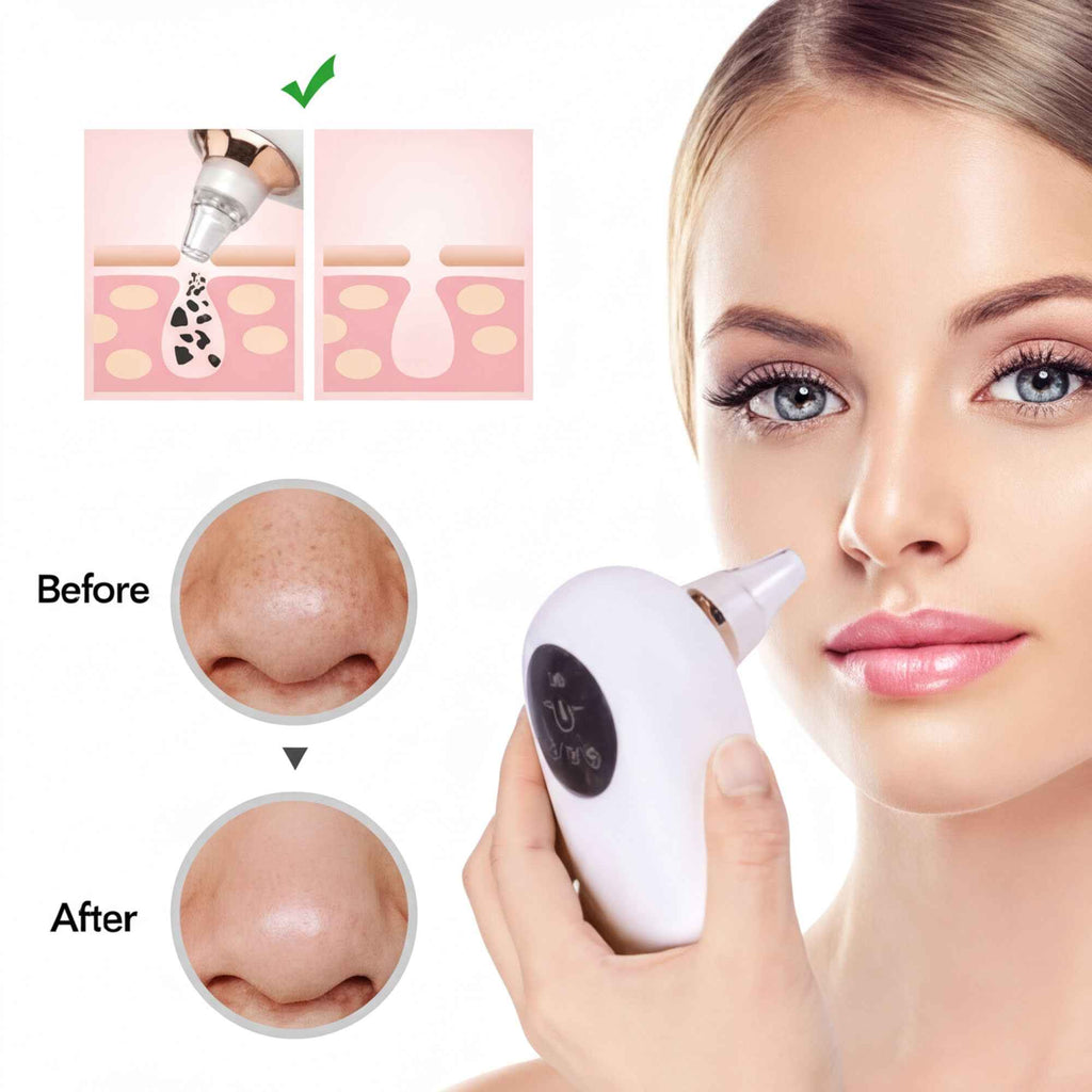 Blackhead Remover Vacuum – Portable Face Deep Pore Cleaner With USB Charging